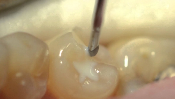 Τι είναι τα sealants